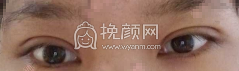 石家庄馨悦张卓男全切双眼皮手术案例|*果|价格