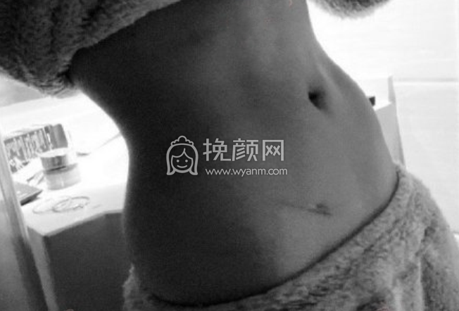 杭州新清吟冀宇腰腹环吸+妈妈臀案例|*果|价格