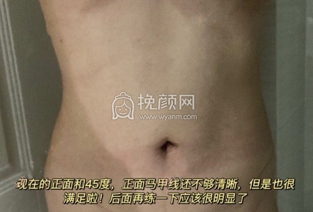 杭州新清吟冀宇腰腹环吸+妈妈臀案例|*果|价格