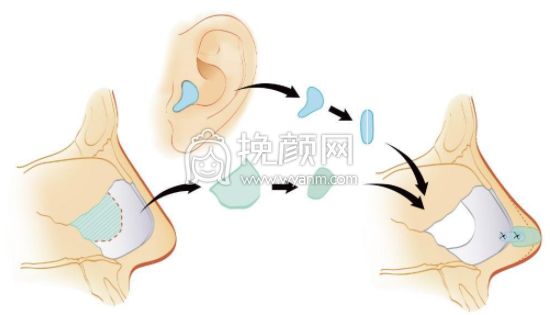武汉协和整形钟爱梅医生做耳软骨隆鼻*果怎么
