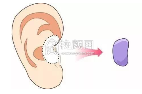 武汉协和整形钟爱梅医生做耳软骨隆鼻*果怎么