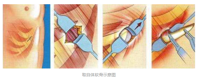 鼻基底凹陷怎么办？【垫鼻基底攻略】