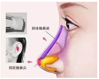 鼻基底凹陷怎么办？【垫鼻基底攻略】