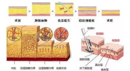 吸脂是否真的可以做到直角腰，筷子腿？