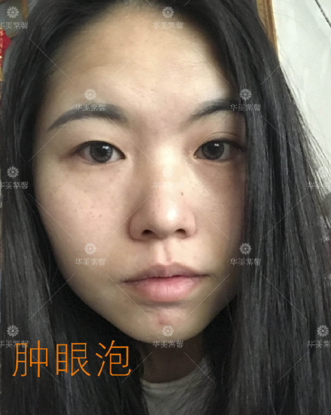 成都华美紫馨美容医院陈杨医生双眼皮开眼角提