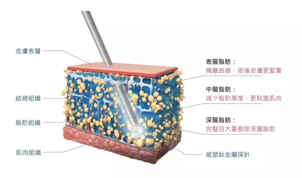 杭州华颜威塑吸大小腿技术怎么样？【案例|盘点