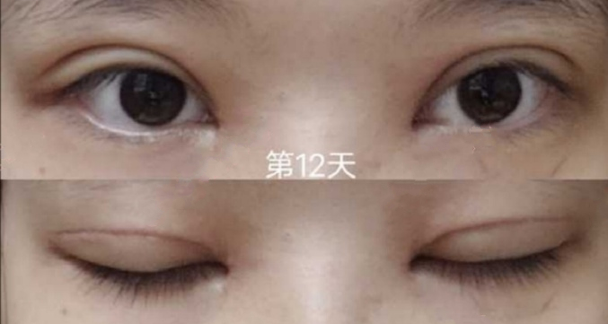 深圳美加美医疗美容邱斌医生双眼皮开眼角提肌