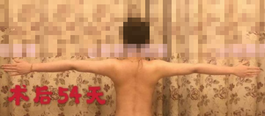 上海刘李娜伯思立医疗手臂副乳肩胛吸脂+射频