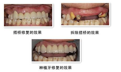 成都青羊圣贝口腔医院陈可矫正牙齿*果怎么样