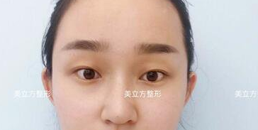 西安美立方医疗美容医院李蓉华割双眼皮怎么样