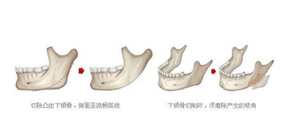 有哪些方法可以改善下颌角？