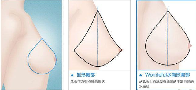 瑞亚高级美医定制做胸部整形价格多少钱？