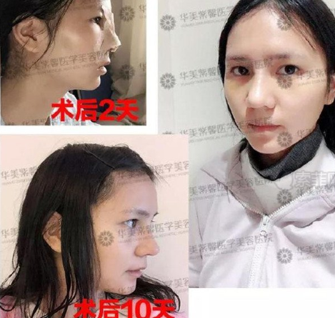 成都华美紫馨陈杨隆鼻怎么样 他的案例负面有吗