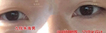 上海九院朱海男双眼皮怎么样 案例有吗？