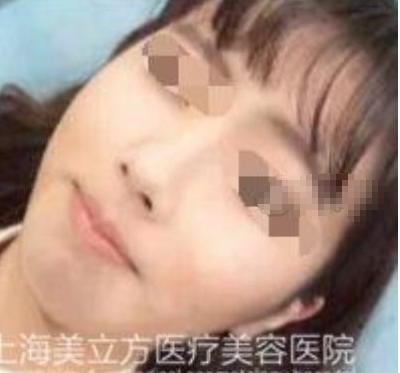 上海美立方医疗美容医生任天平玻尿酸丰下巴