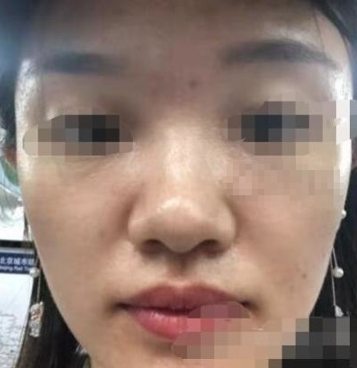 宜昌第二人民医院医学美容科光子嫩肤术后