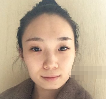 哈尔滨优漾医美医生刘志生自体脂肪全脸填充