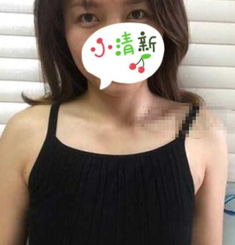 郑州安琪儿医美医生董彭涛自体脂肪隆胸术后