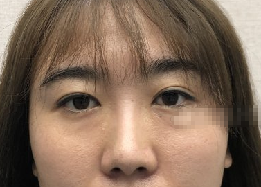 北京中加科洋医美眶隔脂肪释放术后*果如何？