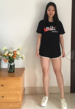 杭州美莱医美翟爽医生大腿吸脂案例分享