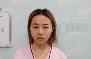 重庆美仑美奂整形医生刘兴振肋软骨隆鼻案例