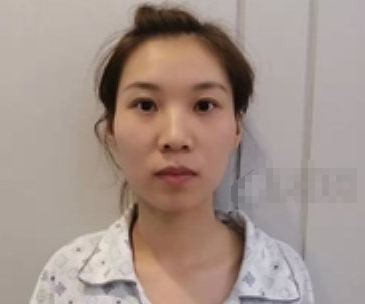 深圳恒丽医美医生王雷自体脂肪填充面部案例