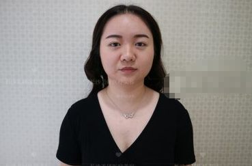 湖南长沙美研医美医生高敏双下巴吸脂案例分享