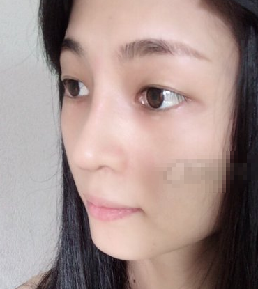 李子鹏隆鼻可靠吗？深圳鹏程医疗美容案例分享