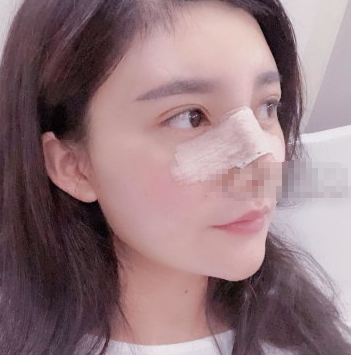 上海华美医疗美容李健医生肋软骨隆鼻怎么样？