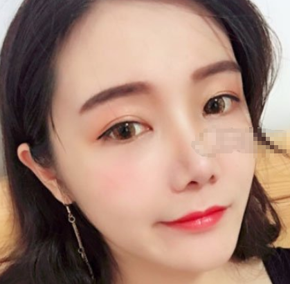 上海华美改脸型如何？V-LINE瓜子脸手术案例展示