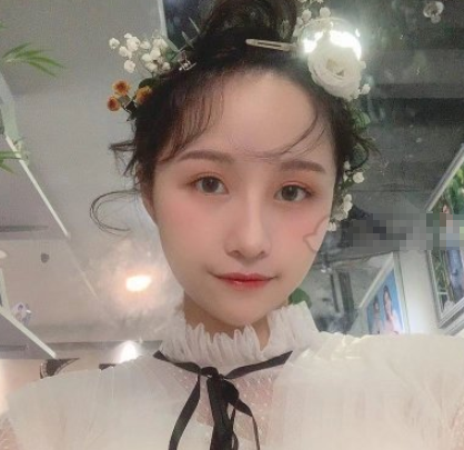 罗延平隆鼻靠谱吗？看下广州美莱这里案例