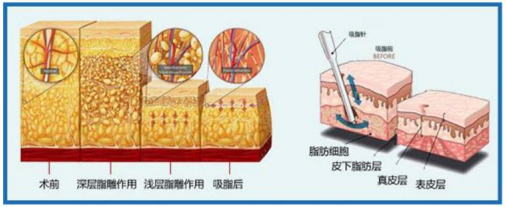 广州高尚整形美容医院韩炜吸脂技术怎么样？